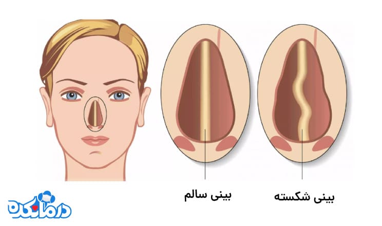 شکستگی بینی چیست؟