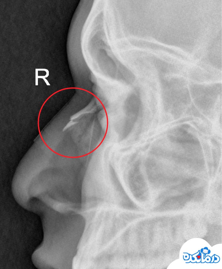 عکس رادیولوژی بینی شکسته