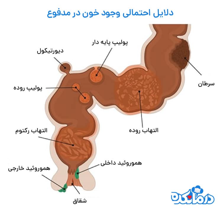 دلایل احتمالی وجود خون در مدفوع