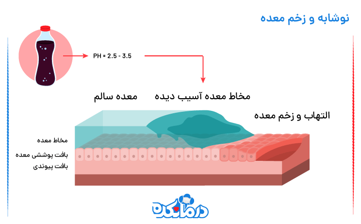 تصویر به صورت گرافیکی تفاوت مخاط آسیب‌دیده معده را به دلیل مصرف نوشابه در برابر مخاط سالم نشان می‌دهد.