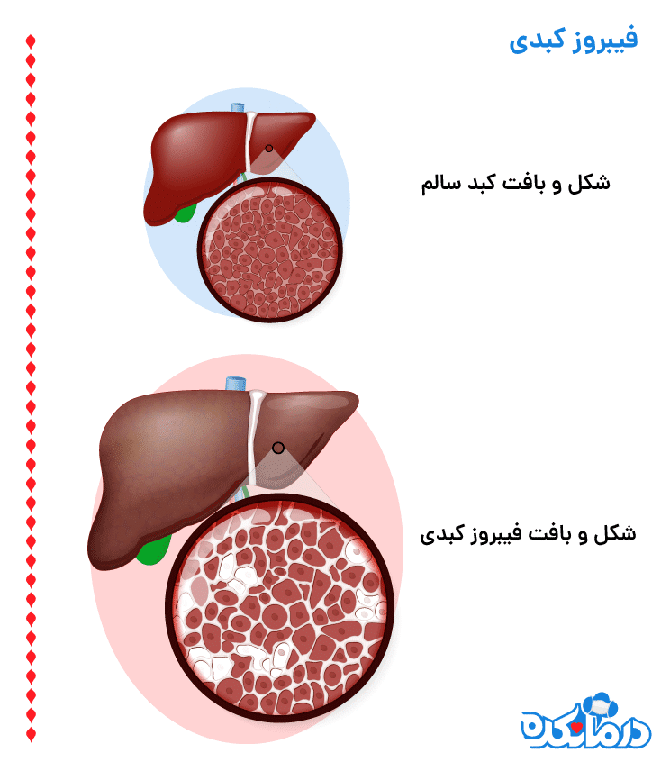 در فیبروز کبدی، بافت سالم کبد زخم می‌شود.