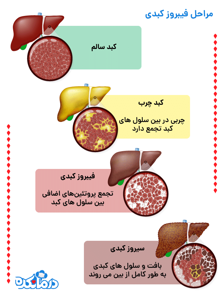 مراحل بیماری کبدی چیست؟