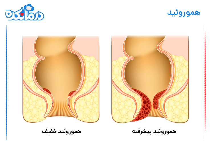 خونریزی در مدفوع به دلیل هموروئید