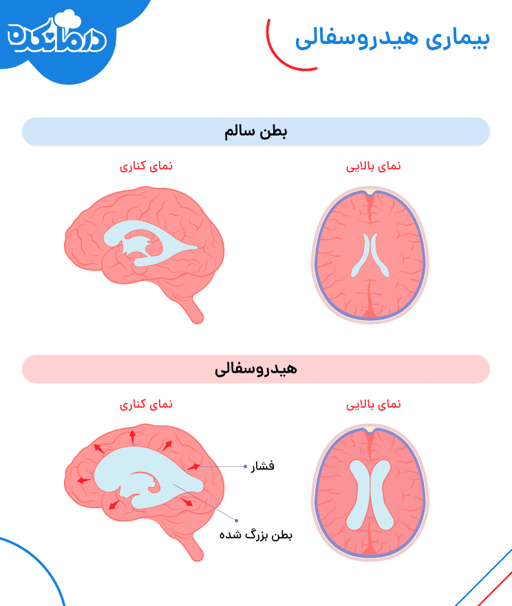 بیماری هیدروسفالی