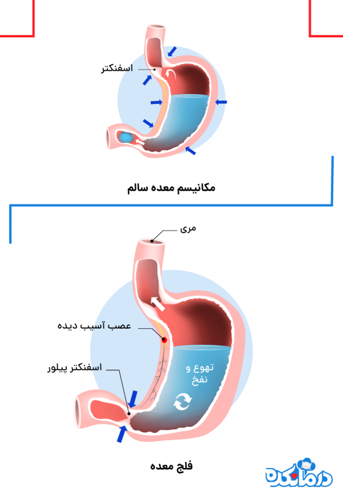 تصویر وضعیت اسفنکتر را در معده سالم و فلج معده نشان می‌دهد.