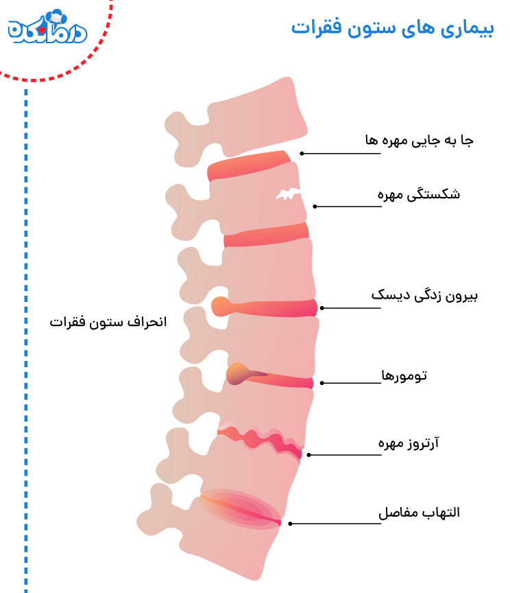 بیماری های ستون فقرات