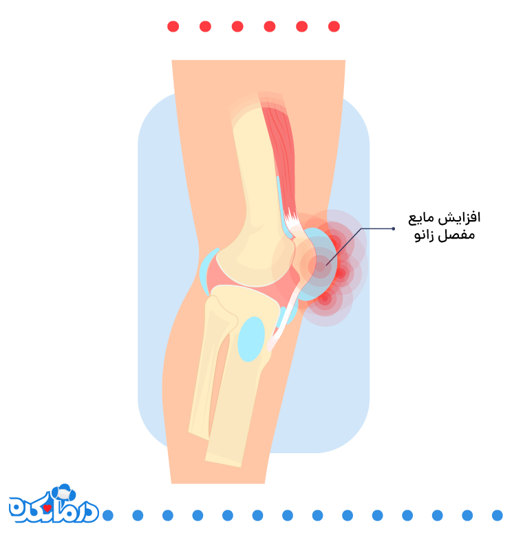 منظور از آب زانو، افزایش مایع مفصلی است.