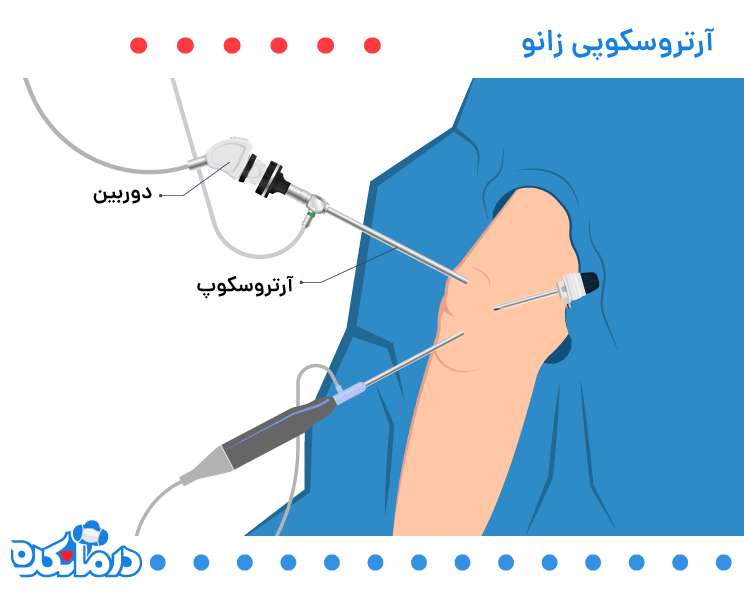 به صورت گرافیکی آرتروسکوپ زانو را می‌بینید.