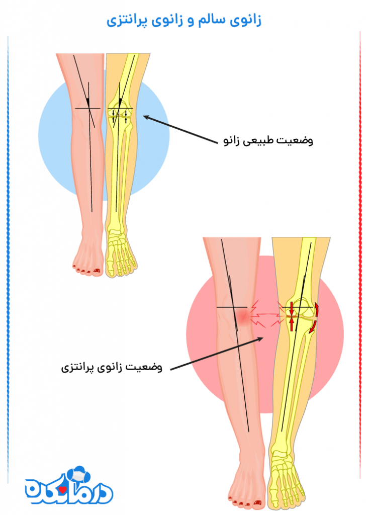 نحوه قرار گرفتن استخوان زانو در حالت طبیعی و  پرانتزی