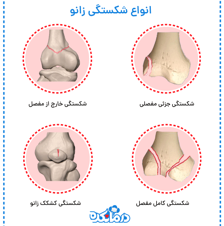 انواع شکستگی استخوان زانو