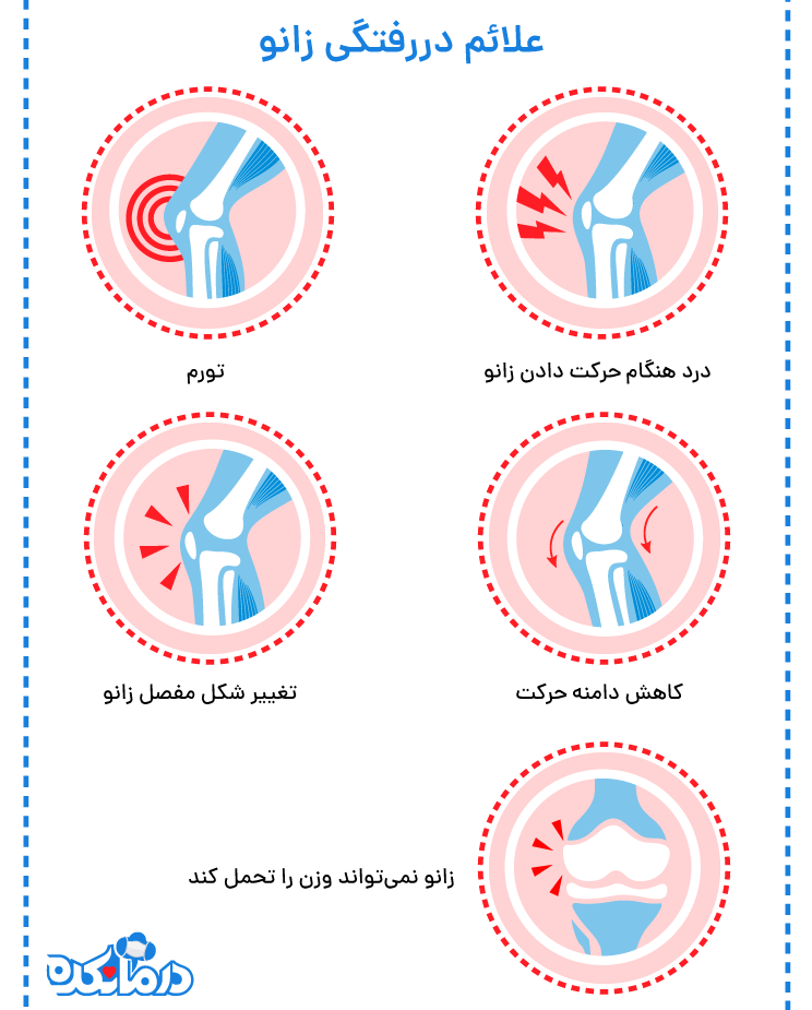 علائم دررفتگی زانو در آسیب‌های زانو