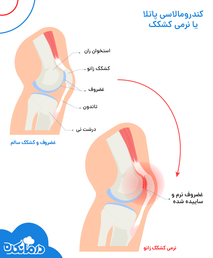 به صورت گرافیکی آناتومی زانو را می‌بینید