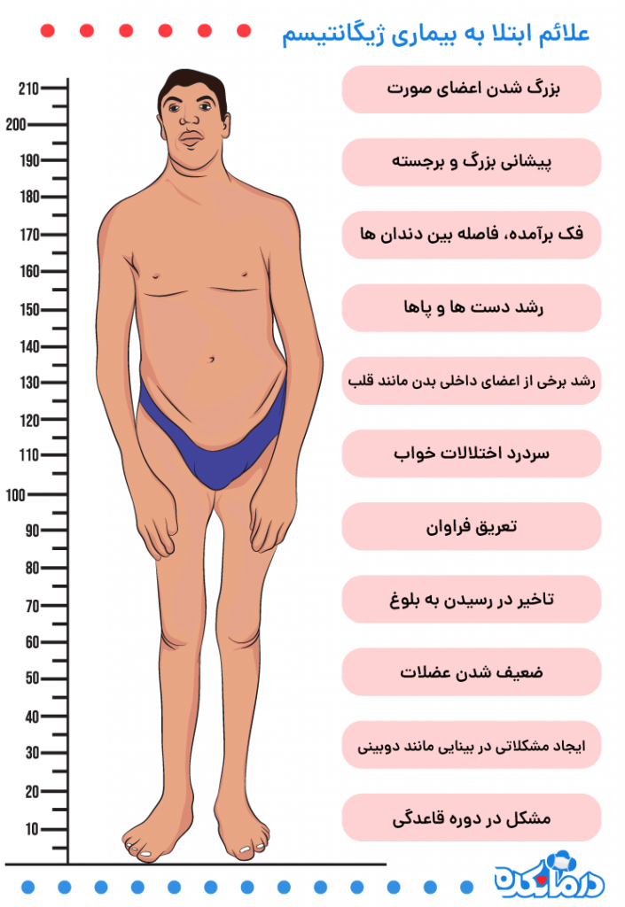 علائم ژیگانتیسم