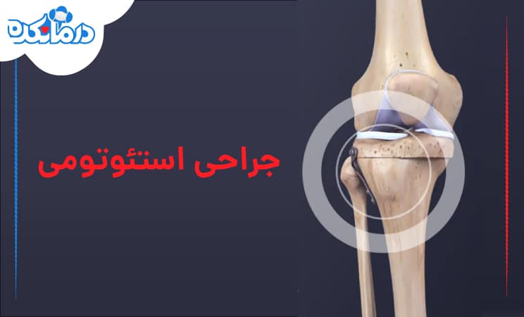 عمل استئوتومی