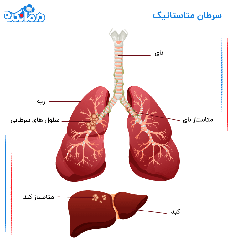 تصویری از متاستاز ایجاد شده در بدن