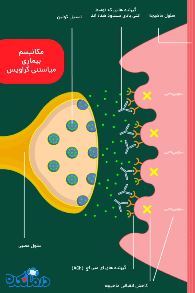 بیماری میاستنی گراویس