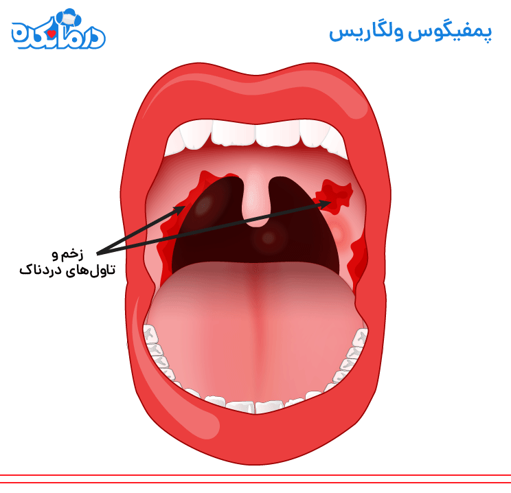 بیماری پوستی پمفیگوس ولگاریس