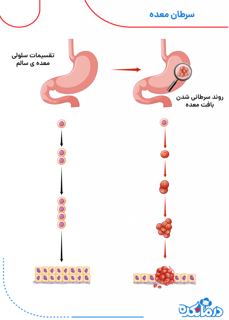 سبک زندگی سالم برای بیماران سرطان معده