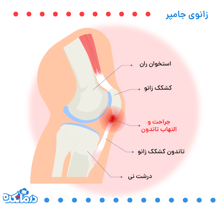 زانوی جامپر