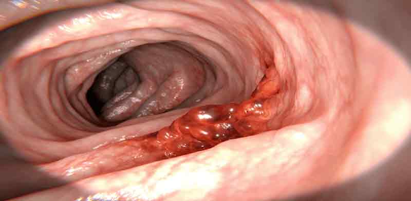 التهاب در روده بزرگ  را می‌بینید که بصورت برآمدگی کوچک قرمز رنگی نشان داده شده است. این التهاب می‌تواند باعث خونریزی مقعد می‌شود.