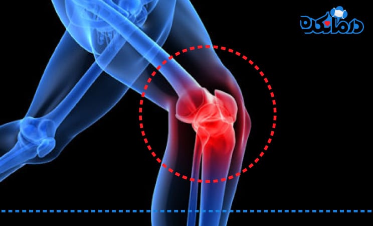 آسیب مفصل زانو نشان داده شده است. زانوی آسیب دیده به رنگ قرمز است.