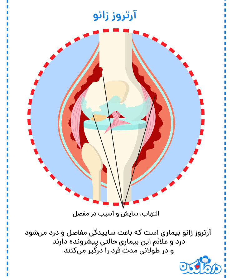 نمای گرافیکی زانو که در آن آسیب غضروف و سایش استخوان‌ها نشان داده شده است.