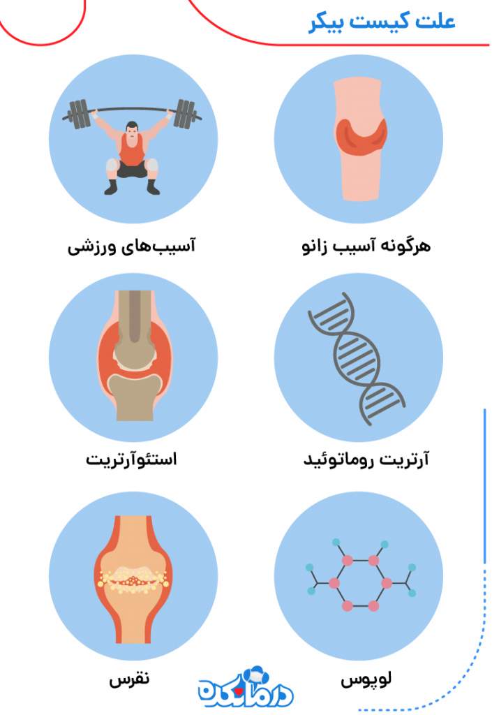 ۶ علت کیست پاپلیتئال