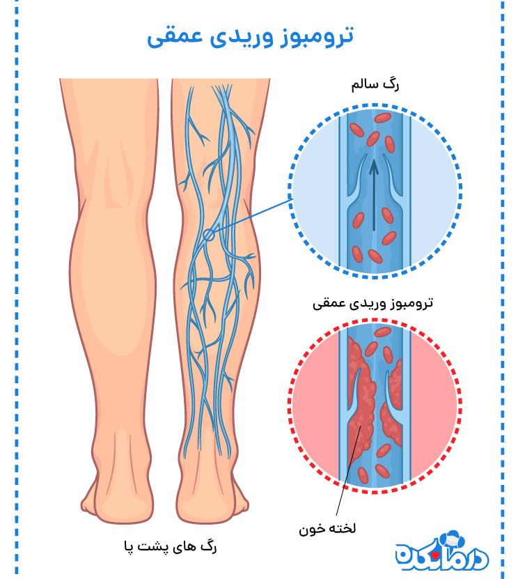 تفاوت رگ سالم در قسمت پشت زانو و ترومبوز وریدی عمقی (DVT)