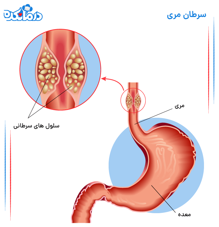 سلول های سرطان مری