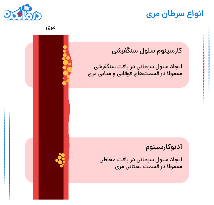 سرطان آدنوکارسینوم مری