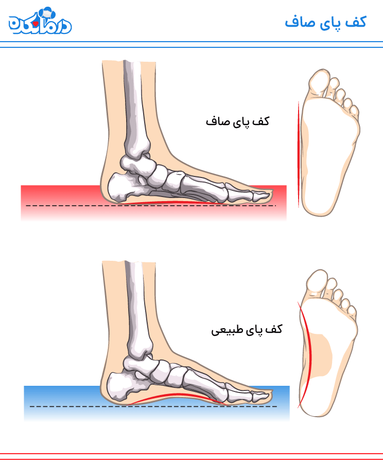 تفاوت کف پای طبیعی و کف پای صاف