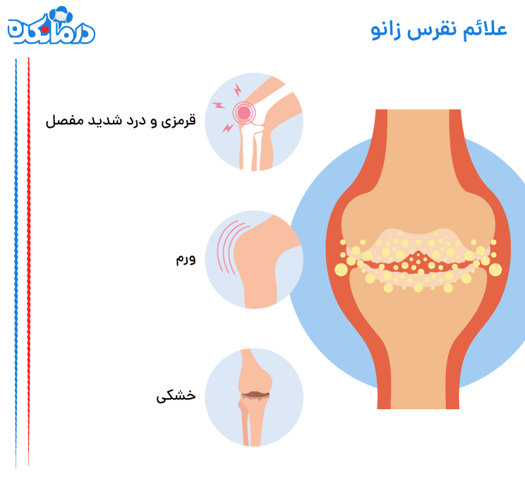 علائم نقرس زانو