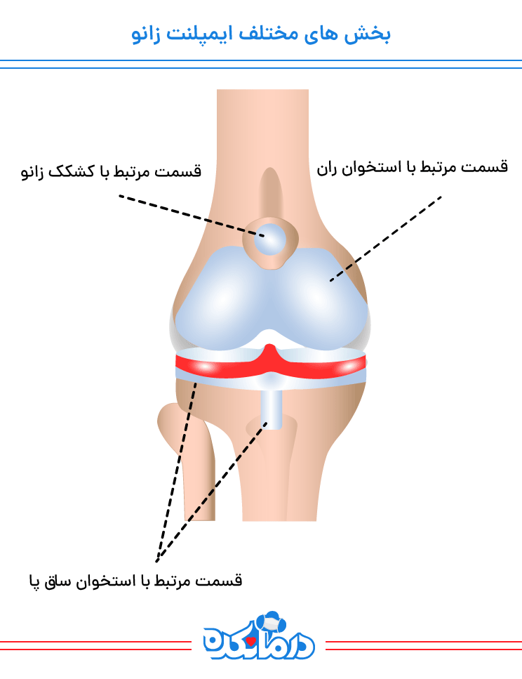 بخش‌های محتلف ایمپلنت زانو