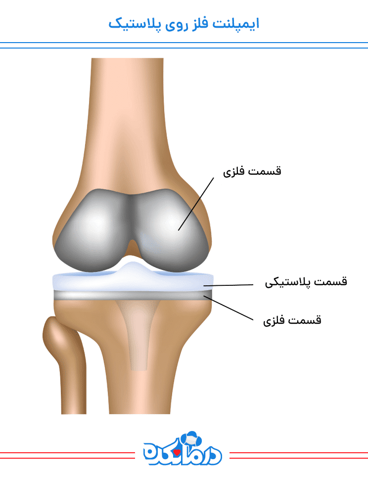 ایمپلنت فلز بر روی پلاستیک، یکی از انواع ایمپلنت زانو.