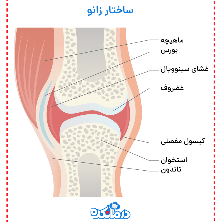 اینفوگرافی از ساختار ورم زیر زانو