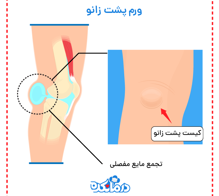 اینفوگرافی از مایع مفصلی و کیست پشت زانو