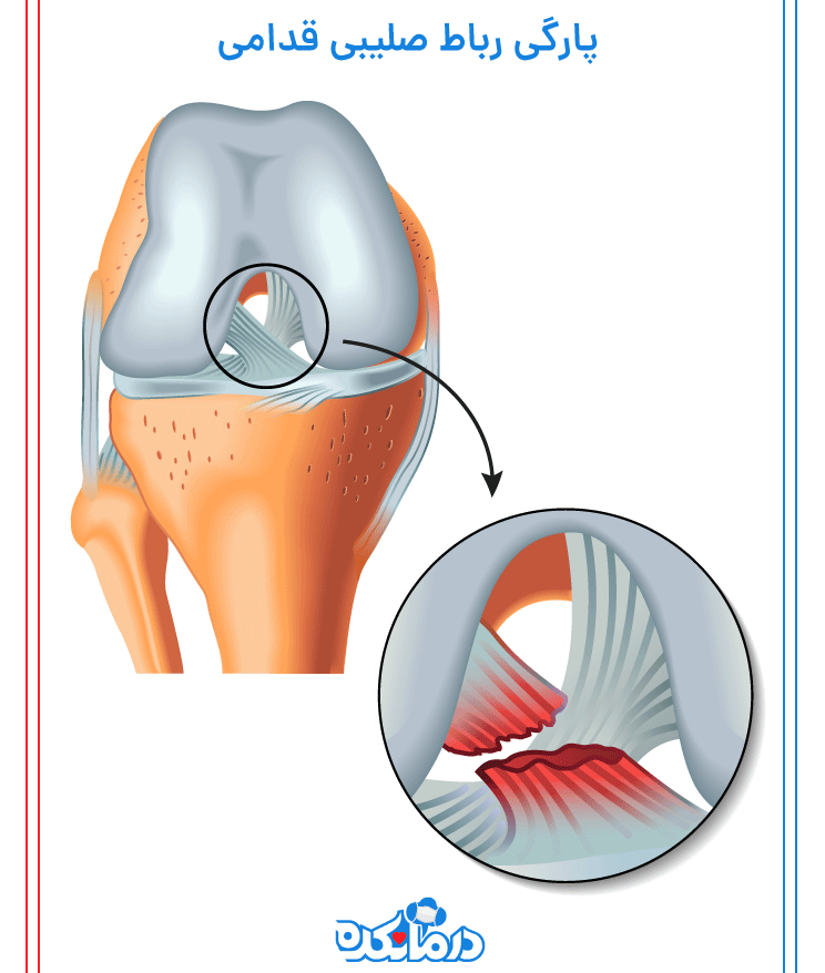 رباط صلیبی و پاره شدن آن| درمانکده