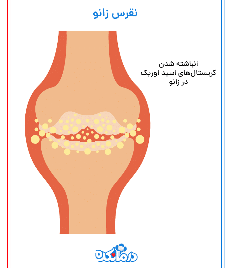 انباشته شدن کریستال‌های اسید اوریک زانو|درمانکده