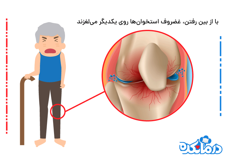 تغییر شکل غضروف زانو با بالا رفتن سن