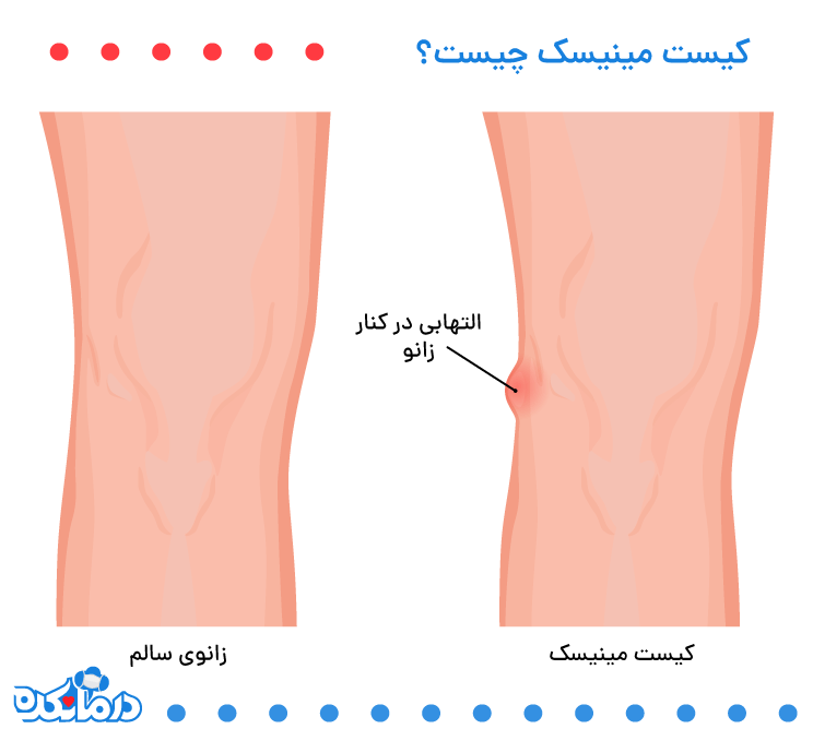 التهاب کیست مینیسک در کنار زانو