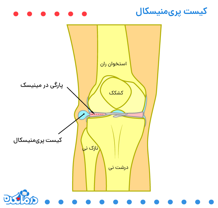 کیست پری‌منیسکال