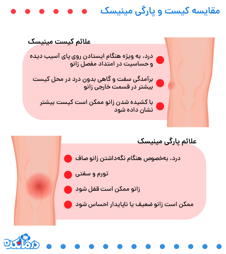 مقایسه کیست و پارگی مینیسک