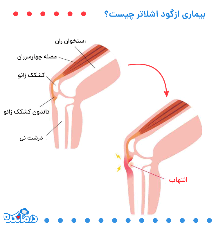 بیماری ازگود اشلاتر