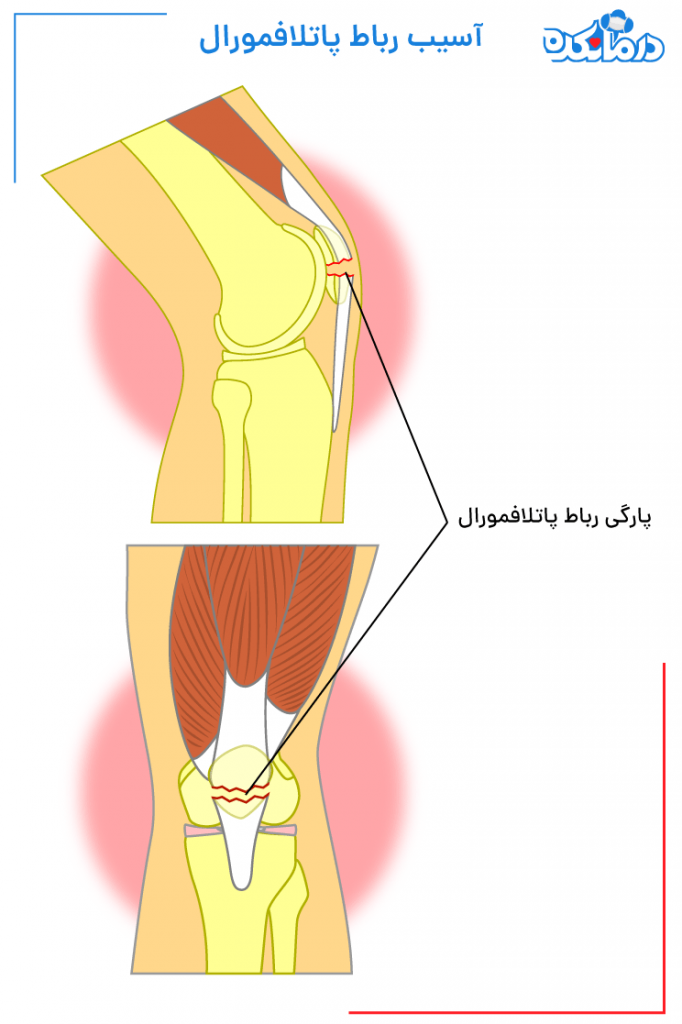 تصویری از پارگی و آسیب به ناحیه رباط پاتلا فمورال زانو