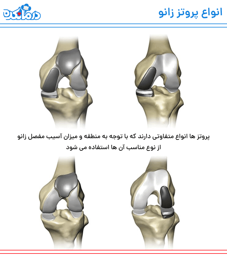 تصویری از انواع پروتز زانو