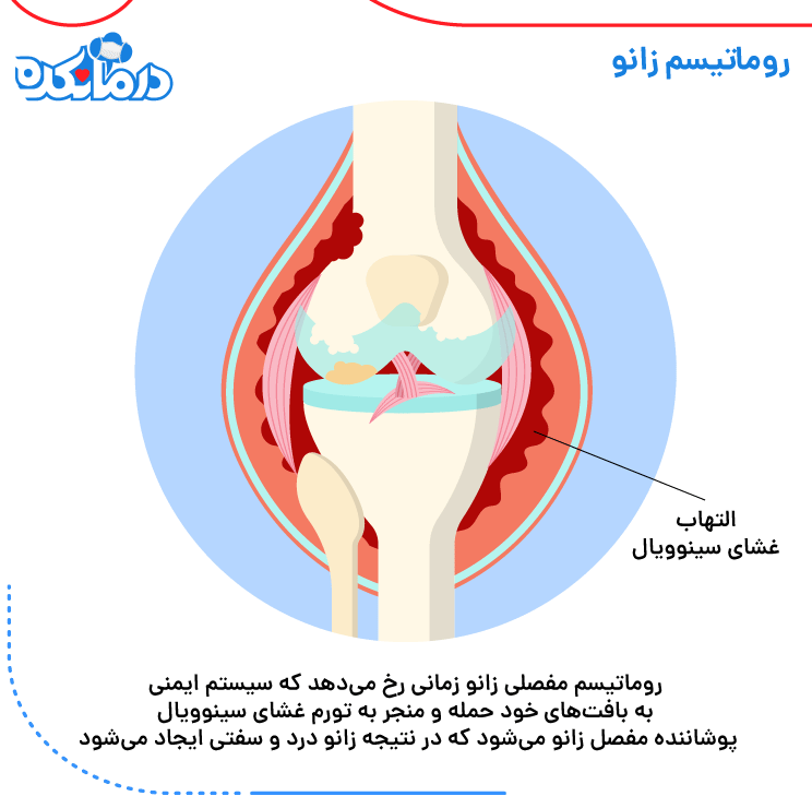 زانوی ملتهب شده از روماتیسم