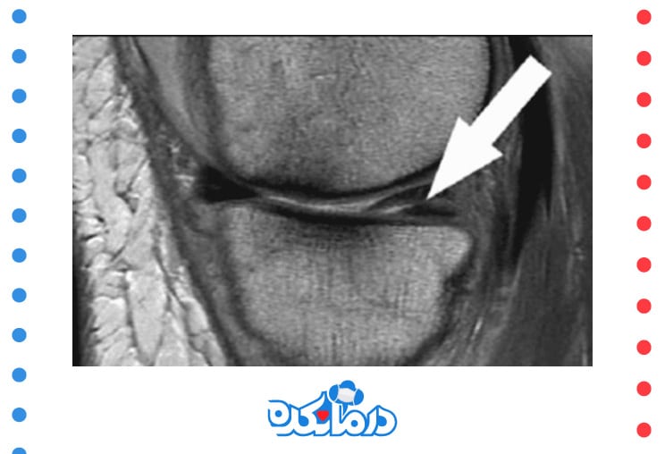 تصویر MRI از پارگی غضروف زانو