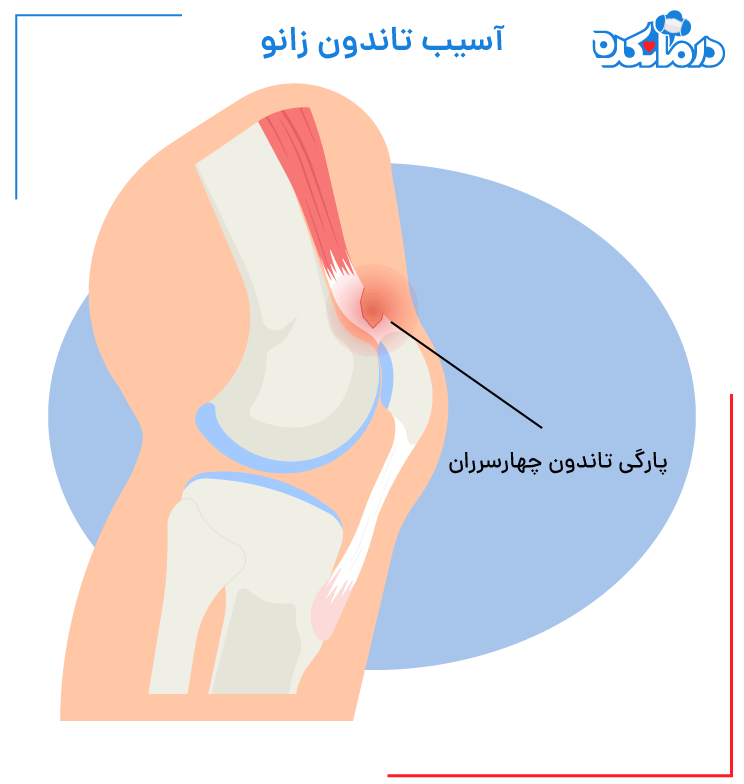 پارگی تاندون زانو