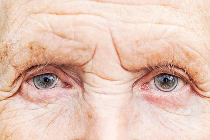 دژنراسیون ماکولای خشک در افراد سن بالا بیشتر رخ میدهد