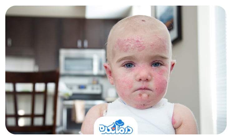 چهره کودکی که مبتلا به بیماری EB است. صورت کودک از پر از تاول‌های قرمز است.